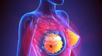5 dấu hiệu ung thư vú dễ nhận biết nhưng thường bị bỏ qua: Cẩn thận di căn xa