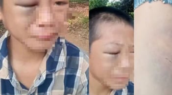 Đang xác minh vụ bé trai 12 tuổi, nghi bị bố và mẹ kế gây thương tích