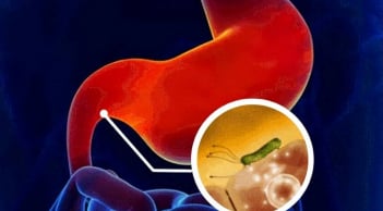 5 dấu hiệu cảnh báo sớm về K dạ dày, biết sớm tăng tỷ lệ sống lên hơn 90%