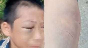 Bé trai nghi bị mẹ kế bạo hành nhiều lần: Người bố lên tiếng xin lỗi gia đình vợ cũ