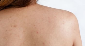 Mụn lưng bùng phát vào mùa hè: Những cách chăm sóc giúp da cơ thể thông thoáng hơn