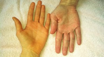 6 dấu hiệu trên cơ thể cảnh báo gan của bạn đang kêu cứu: Nên đi khám gấp