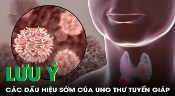5 dấu hiệu K tuyến giáp mới chớp: Biết sớm chữa là khỏi