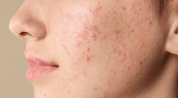 5 cách giúp giảm mụn cám tại nhà, hỗ trợ da thông thoáng và mịn màng hơn
