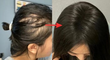 Lời khuyên dành phụ nữ có tóc rụng nhiều, mọc chậm, tóc càng ngày càng mỏng