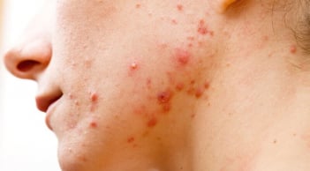 4 cách chăm sóc da khi bị mụn nhọt để hạn chế thâm sẹo và giúp da hồi phục nhanh hơn