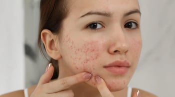 Cách làm mờ thâm mụn bằng kem đánh răng tại nhà