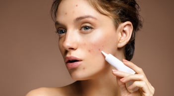 6 cách giúp làm mờ thâm sau mụn và phục hồi làn da sáng khỏe hiệu quả hơn