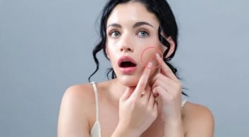 Chăm sóc da đúng cách sau nặn mụn giúp giảm nguy cơ thâm sẹo và phục hồi da nhanh hơn