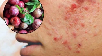 3 đối tượng không được ăn mận: Dễ nổi mụn, nóng trong