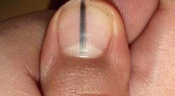5 dấu hiệu trên móng tay cảnh báo bệnh nan y: Có 1 trong 5 dấu hiệu cũng nên đi khám gấp