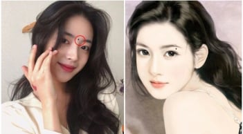 3 nốt ruồi trên mặt mang tới may mắn: Đừng dại xóa đi