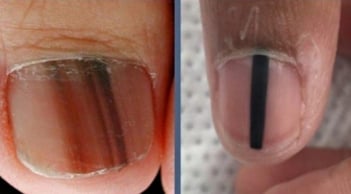 Cảnh báo từ Bác sĩ Da liễu Trung ương: 5 dấu hiệu trên móng tay có thể là 'án tử' ung thư ác tính