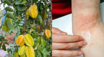  Mách mẹo làm giảm rôm sảy, mẩn ngứa bằng lá khế: Dân gian dùng nhiều nhưng cần biết đúng cách