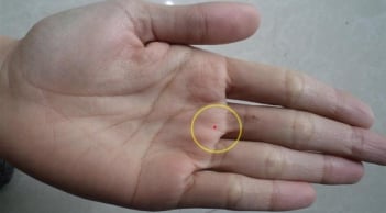 4 nốt ruồi trên bàn tay mang tới may mắn cho bạn: Ai có thật đáng chúc mừng