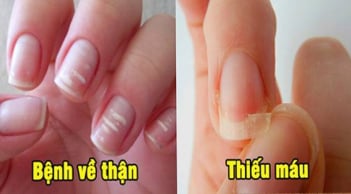 Bắt bệnh qua móng tay: Có 1 dấu hiệu cũng nên đi khám sớm