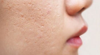 3 lầm tưởng phổ biến về điều trị sẹo mụn khiến nhiều người tốn thời gian mà hiệu quả không như mong đợi