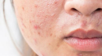 Muốn ngăn mụn tái phát? Đừng bỏ qua 6 bước chăm sóc da giúp duy trì làn da khỏe mạnh
