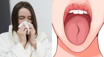 Lưỡi có 3 dấu hiệu này: Nên đi khám càng sớm càng tốt