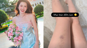 Thúy Ngân đăng tải bức ảnh cận cảnh đôi chân với nhiều vết thương