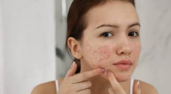 7 loại mặt nạ thiên nhiên hỗ trợ làm mờ thâm mụn, giúp da sáng khỏe tại nhà