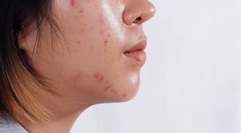 4 thói quen khiến da dầu dễ nổi mụn hơn mỗi ngày, nhiều người vẫn vô tình mắc phải