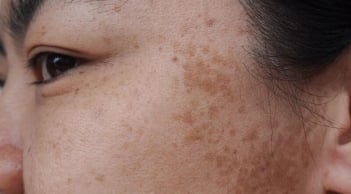 5 thói quen hằng ngày âm thầm khiến làn da dễ bị nám, nhiều người vẫn lặp lại mà không hay biết