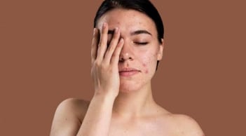 Kem chấm mụn có thực sự hiệu quả? Cách chọn và sử dụng đúng để mụn nhanh phục hồi