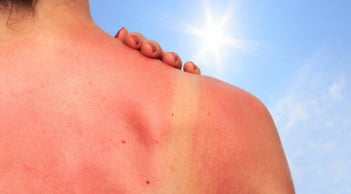 Làn da cháy nắng sau kỳ nghỉ: Những bước phục hồi giúp da nhanh dịu, khỏe và đều màu trở lại