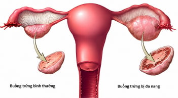 Đa nang buồng trứng đổi tên sau 90 năm - Nhiều phụ nữ từng bị hiểu sai