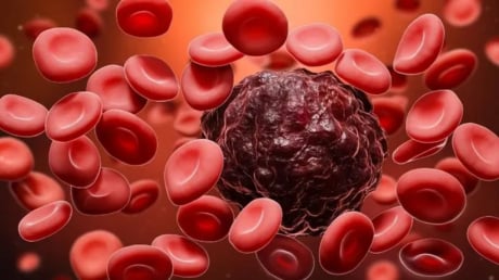 Xét nghiệm máu phát hiện ung thư sớm trước 3 năm
