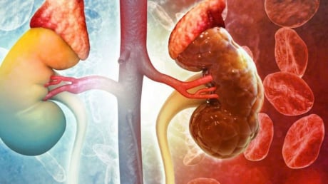 8 dấu hiệu cảnh báo suy thận giai đoạn đầu: Xem thường chạy thận cả đời
