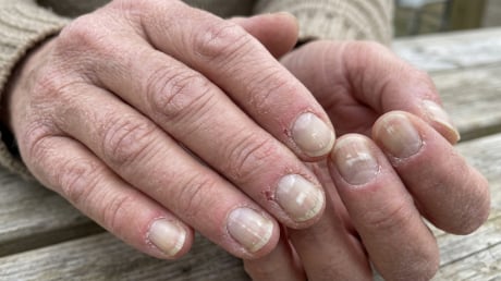 Tay và chân xuất hiện 7 dấu hiệu này, có thể là tín hiệu thận đang gặp vấn đề