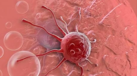 3 căn bệnh ung thư này tiến triển với tốc độ đáng báo động, cách phát hiện sớm