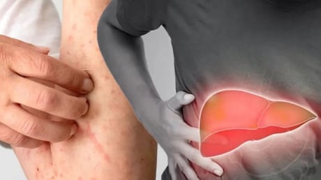5 biểu hiện sớm của bệnh gan có 1 dấu hiệu cũng nên đi khám sớm