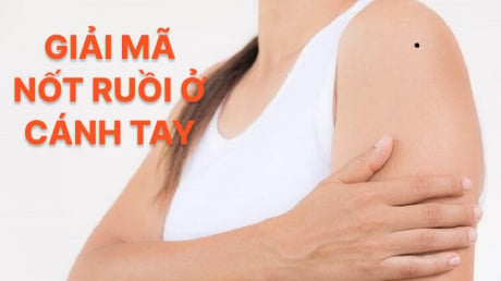 4 nốt ruồi trên cánh tay mang tới may mắn cho bạn: Đừng dại xóa đi