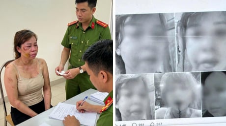 Người mẹ sau sinh lên tiếng tố chồng bạo hành, pháp luật đã vào cuộc