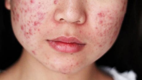 Căng thẳng kéo dài có thể khiến mụn trứng cá dai dẳng và khó kiểm soát