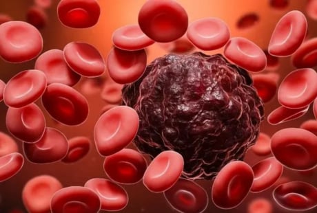 Xét nghiệm máu phát hiện ung thư sớm trước 3 năm