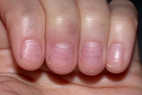 Nhìn móng tay bắt bệnh cực kỳ chính xác