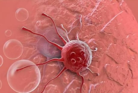 3 căn bệnh ung thư này tiến triển với tốc độ đáng báo động, cách phát hiện sớm