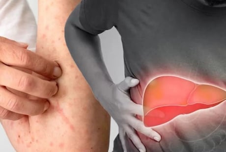 5 biểu hiện sớm của bệnh gan có 1 dấu hiệu cũng nên đi khám sớm