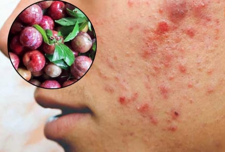 3 đối tượng không được ăn mận: Dễ nổi mụn, nóng trong