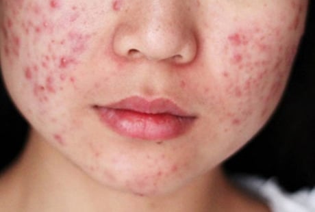 Căng thẳng kéo dài có thể khiến mụn trứng cá dai dẳng và khó kiểm soát