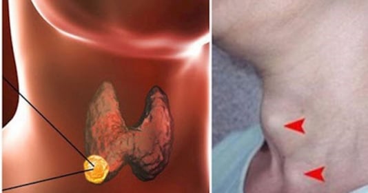 8 triệu chứng rõ mồn một của K tuyến giáp: Bác sĩ nói nhiều người ở giai  đoạn nặng rồi mà không biết
